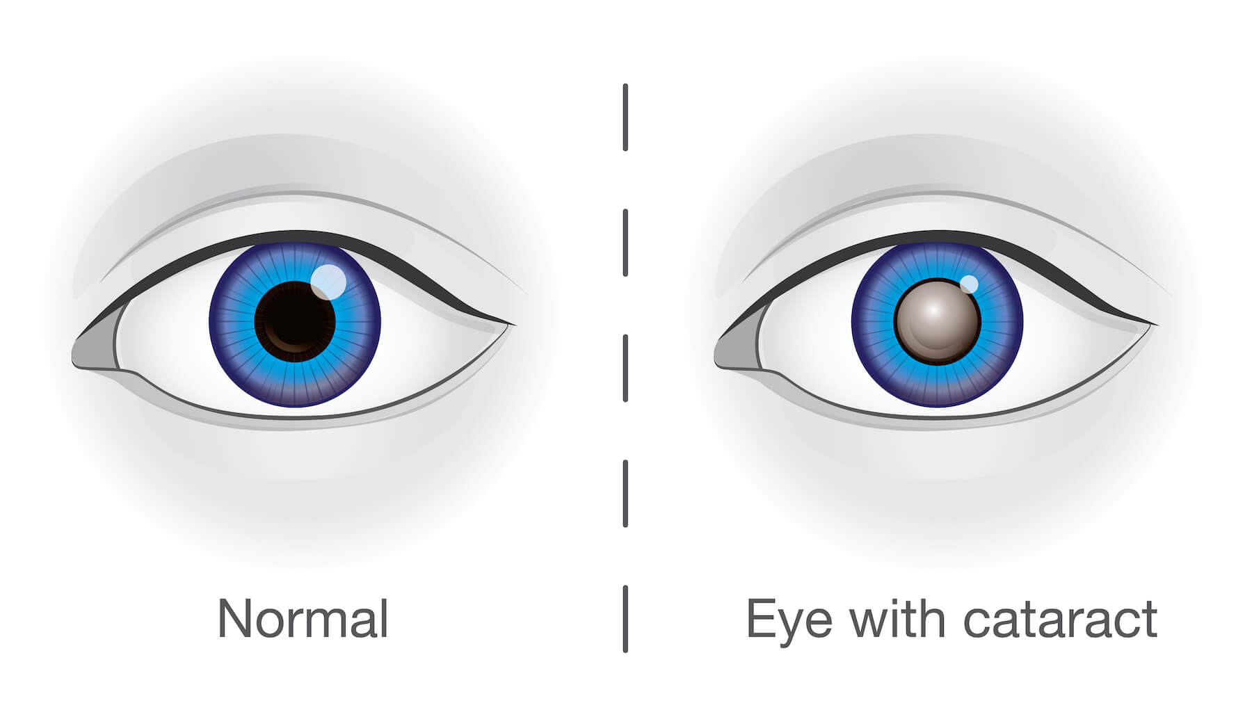 Graphic showing a diagram of what a cataract is.