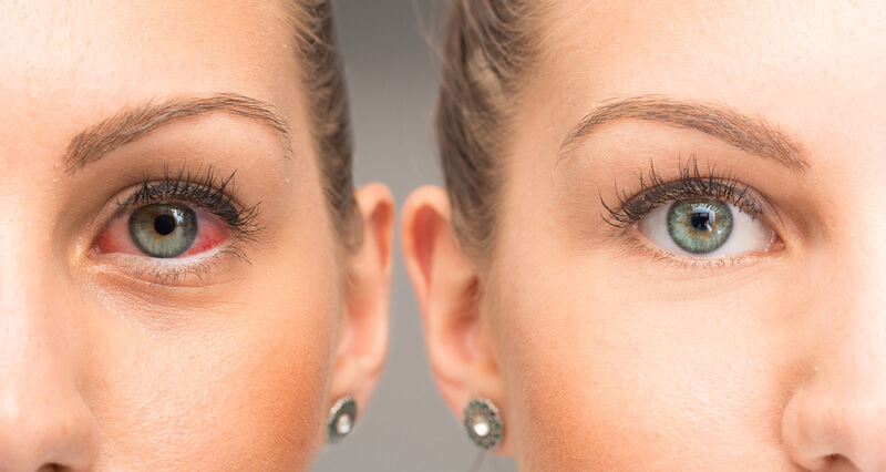 Woman with dry eye before and after treatment