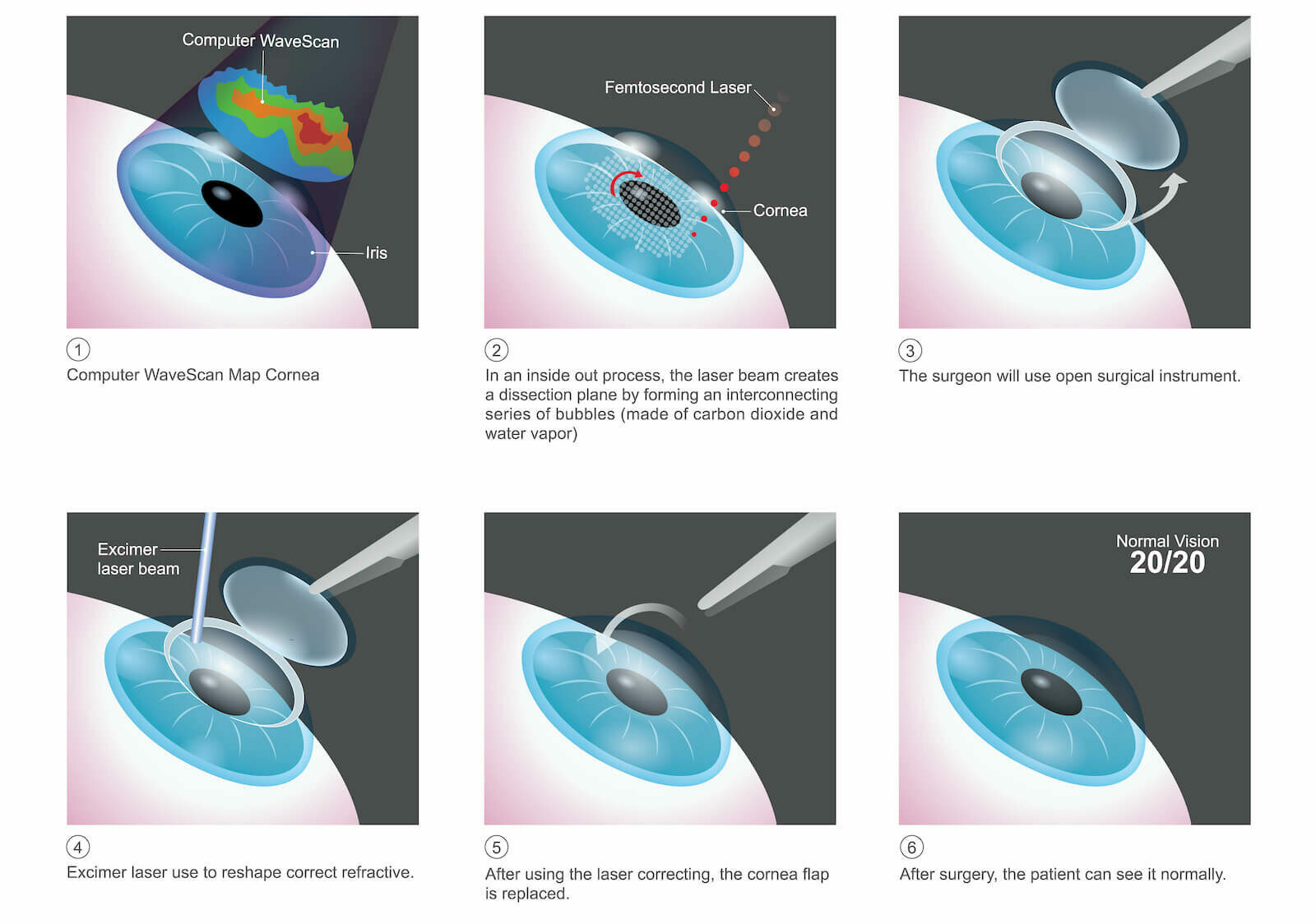The method used by Blade-free LASIK lasers to create cornea flaps is claimed to enhance the safety of LASIK surgery.