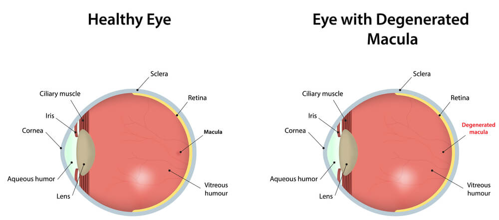 Age Related Macular Degeneration