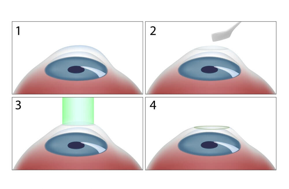 Graphic showing the steps for Photorefractive Keratectomy procedure